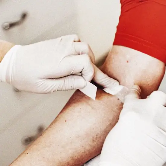 Lipoprotein (A); LP(A)